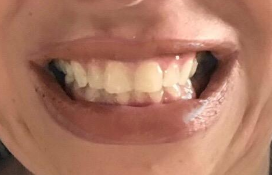 Teeth Whitening Strips